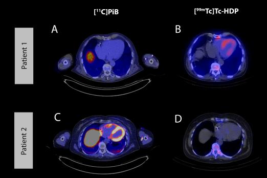 Nucleaire beeldvorming bij transthyretine-amyloïd cardiomyopathie