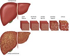 Hepatitis C, the silent killer overwonnen?