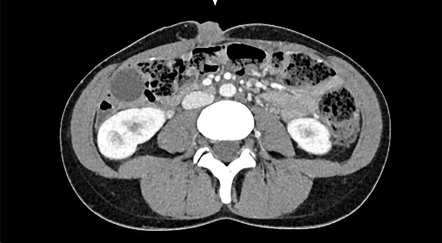 Richtlijn Colorectaal carcinoom