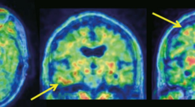 Traumatisch hoofd/hersenletsel als risicofactor voor een neurodegeneratieve aandoening: traumatische encefalopathie 