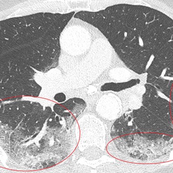 Thoracale beeldvorming bij COVID-19-infectie 