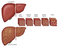 Hepatitis C, the silent killer overwonnen?
