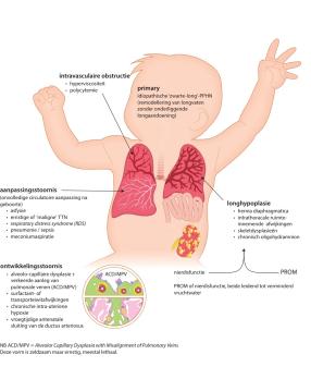 Persisterende pulmonale hypertensie bij de neonaat (PPHN)