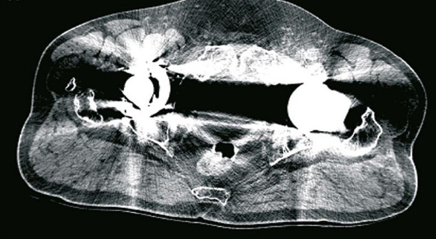 Metaalartefactreductietechnieken in musculoskeletale CT-beeldvorming