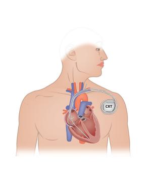 Chronisch hartfalen: van diagnostiek naar behandeling