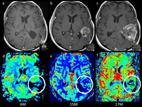 Aankleuring na behandeling van een GBM: tumorrecidief of therapie-effect?