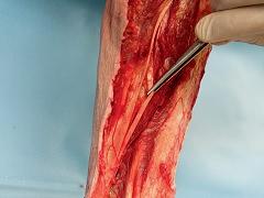 Oefentherapie bij een tendinopathie van de achillespees en de patellapees: een literatuuroverzicht