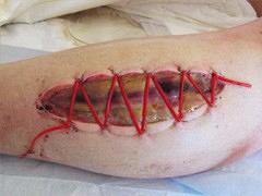 Acuut compartimentsyndroom van het onderbeen