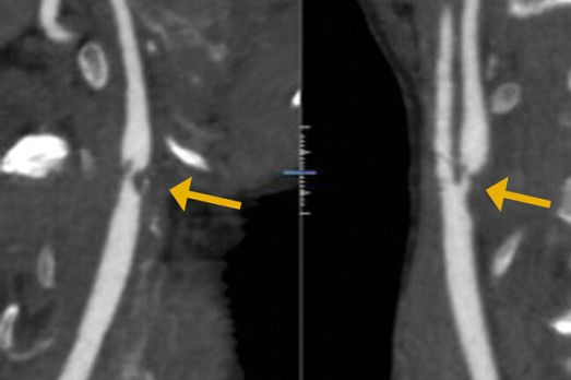 Stenting van de arteria carotis 