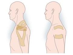 Wat is het klinisch effect van elastische tape bij schouderklachten?