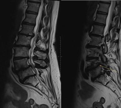 Multidisciplinair samenwerken bij lage rugpijn vraagt om gedeeld denken en doen