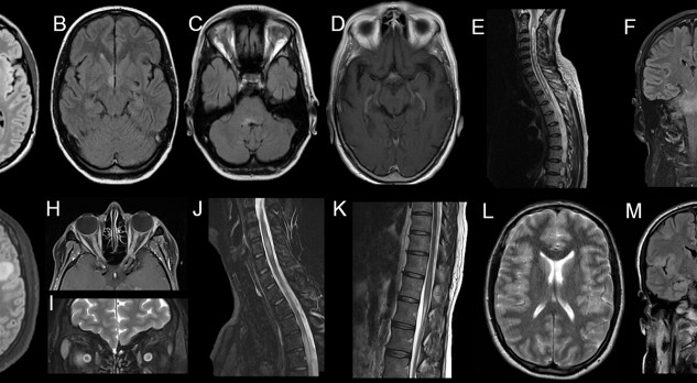 Neuromyelitis optica-spectrumstoornis en MOG-geassocieerde ziekte 