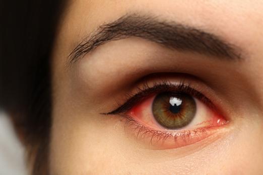 Oogaandoeningen met een rood oog