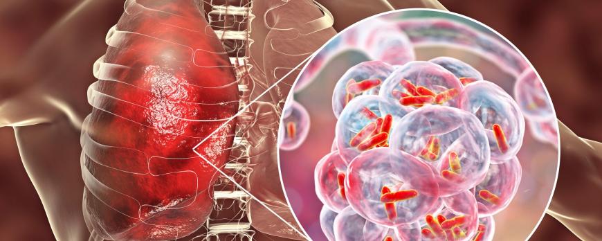 Antimicrobial Stewardship voor de kritiek zieke patiënt