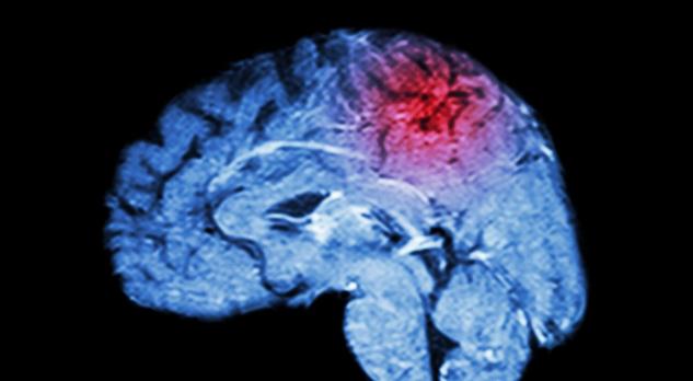 Herseninfarct