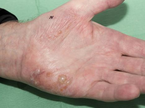 Arbeidsdermatologie: inleiding en pathofysiologie