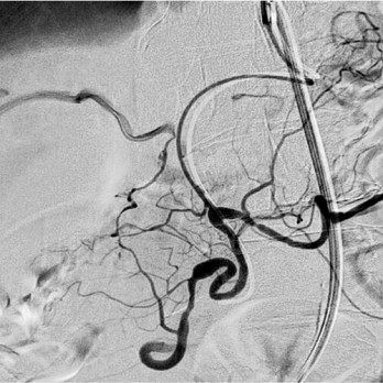 Segmentele arteriële mediolyse