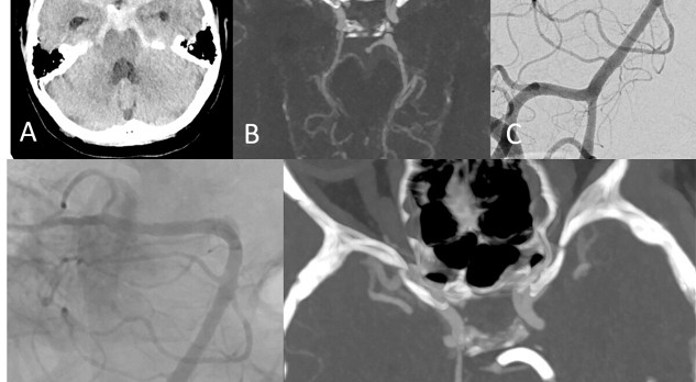 Hersenaneurysma's: typen en behandeling 