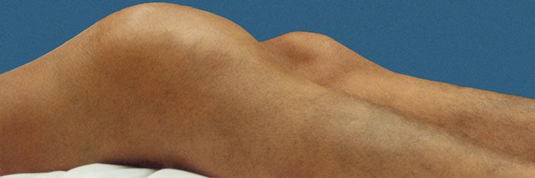 Hemofilie, een hematologische aandoening met gevolgen voor het bewegingsapparaat