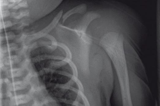 Röntgenfoto bij verdenking op neonatale claviculafractuur