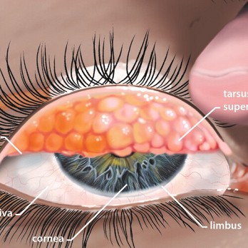 Keratoconjunctivitis vernalis 