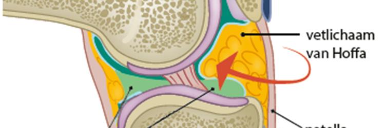 Patellofemoraal impingement van het vetlichaam van Hoffa