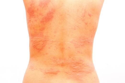 Urticaria en eczeem