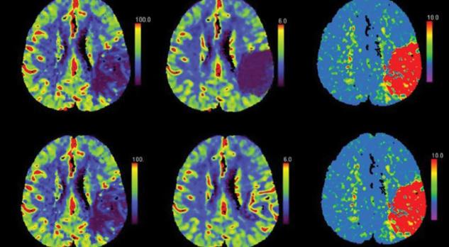 Rol van CT-perfusie in de diagnostiek van het herseninfarct en in de selectie van patiënten voor endovasculaire behandeling