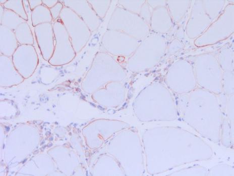 Meer dan een spierziekte: myotone dystrofie type 1