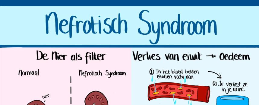 Infographic nefrotisch syndroom
