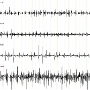 Klinisch neurofysiologisch onderzoek bij bewegingsstoornissen