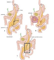 Inwendige herniatie na gastric bypass