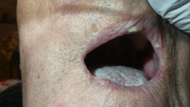 Mondproblemen in de palliatieve fase: droge mond, infecties en ontstekingen