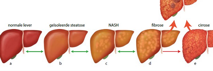 Non-alcoholic fatty liver disease