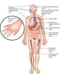 Systemische lupus erythematodes