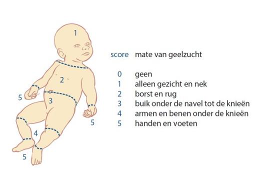 Hoe (on) betrouwbaar is de visuele beoordeling van neonatale icterus?