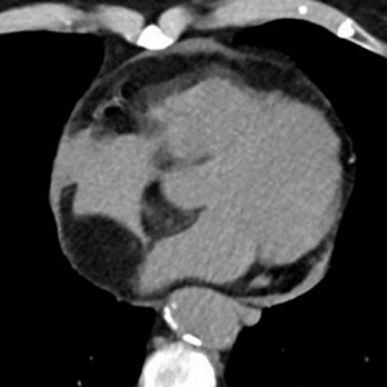 Lipomateuze hypertrofie van het interatriale septum (LHIS) 