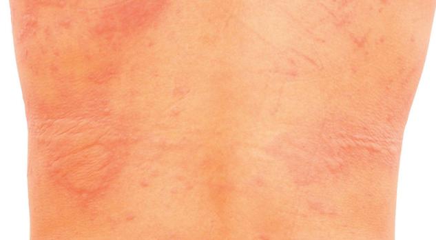 Urticaria en eczeem