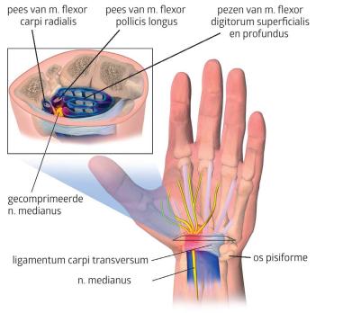 Carpaletunnelsyndroom 