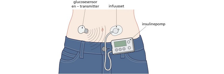 Insulinepompen en glucosensoren op de OK 