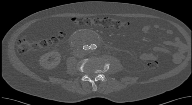 Het acute aneurysma van de aorta abdominalis: snelheid en expertise vereist