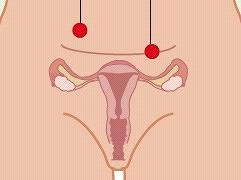 Zorgen bij extra-uteriene graviditeit (EUG)