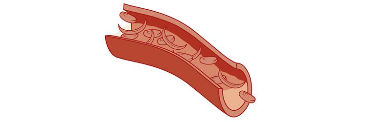 Kan hemoglobinopathie de oorzaak zijn van moeheid?