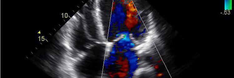 Cardiomyopathie, verzamelnaam van veel problemen en (nog steeds) te weinig oplossingen