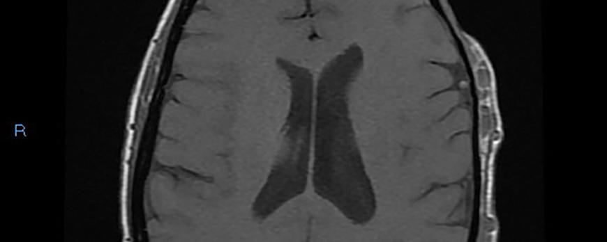 Vasculaire anomalieën