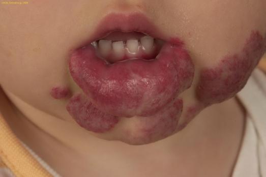 Agressieve vaatanomalieën bij kinderen