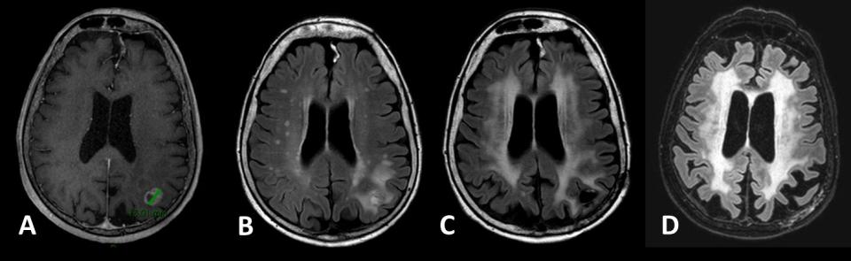 Behandeling van hersenmetastasen in de klinische praktijk 