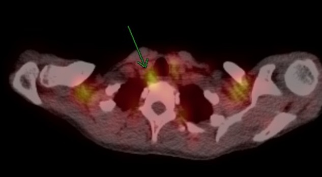 Primaire hyperparathyreoïdie: beeldvormend onderzoek voor diagnostiek en ondersteuning van minimaal-invasieve chirurgie 