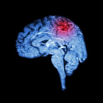 Herseninfarct