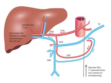 Tumortagging bij CT hepatische arteriografie-geleide thermale ablatie